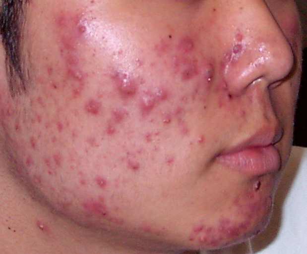 Acne - causes and treatment - Offline Clinic