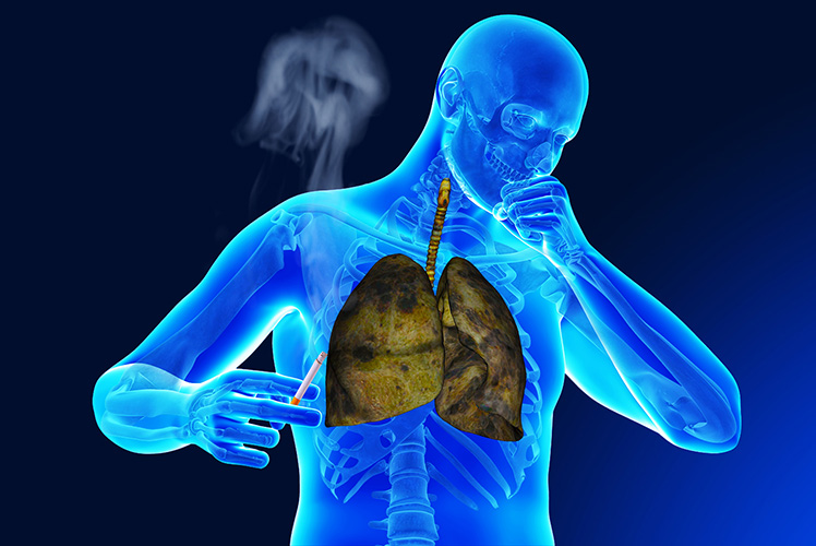 chronic-obstructive-pulmonary-disease