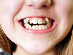 underbite, overbite & crooked teeth