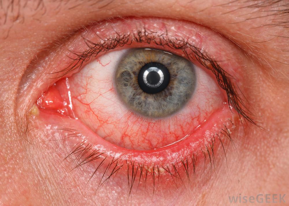 Do Eye Drops Expire Offline Clinic