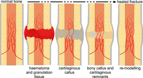 bone fracture healing process