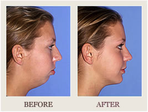jaw surgery before after overbite