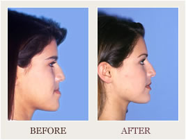 jaw surgery before after underbite