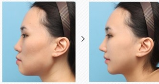 jaw surgery before after underbite