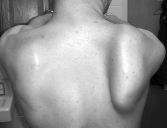winging of scapula